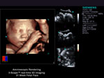 Amnioscopic