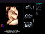 Amnioscopic
